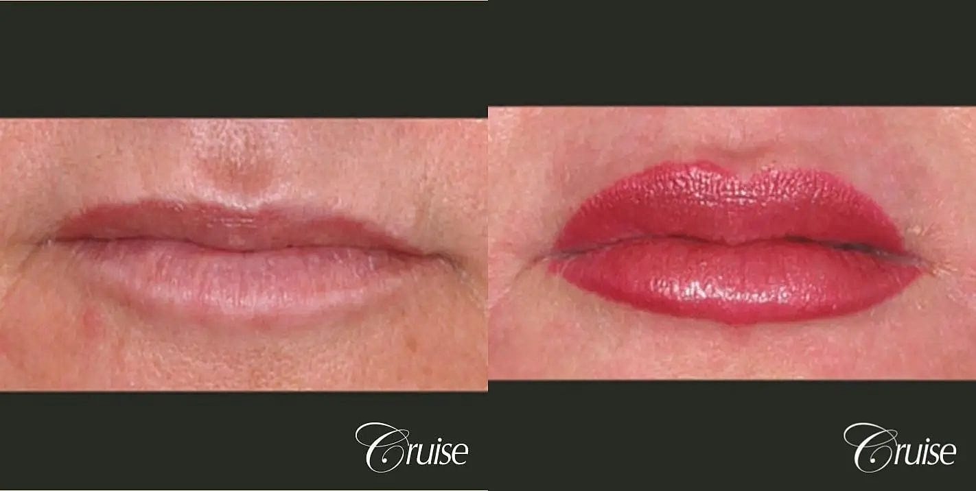 Dermal Fillers Before & After