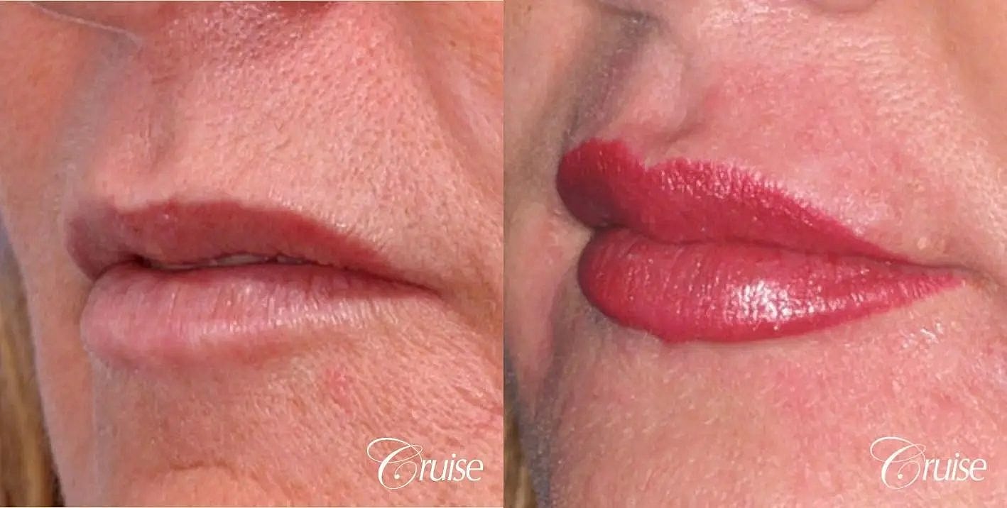 Dermal Fillers Before & After