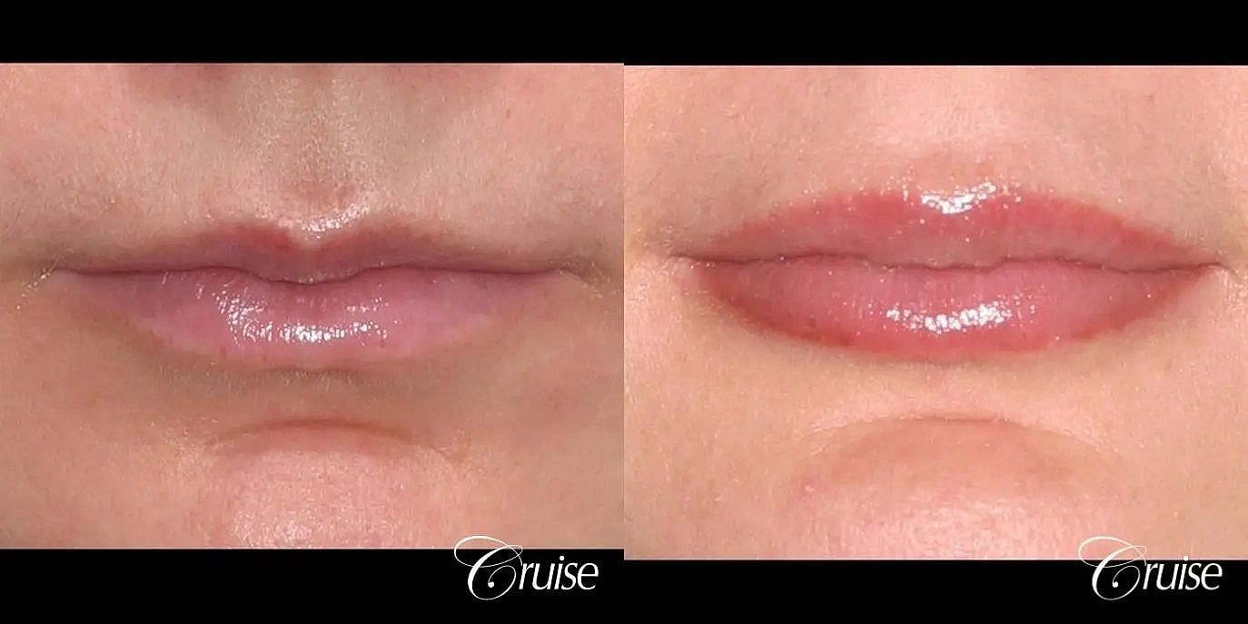 Dermal Fillers Before & After