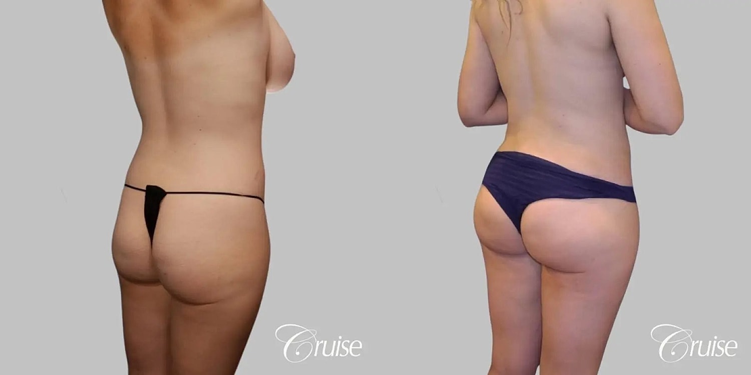 Brazilian Butt Lift Before & After