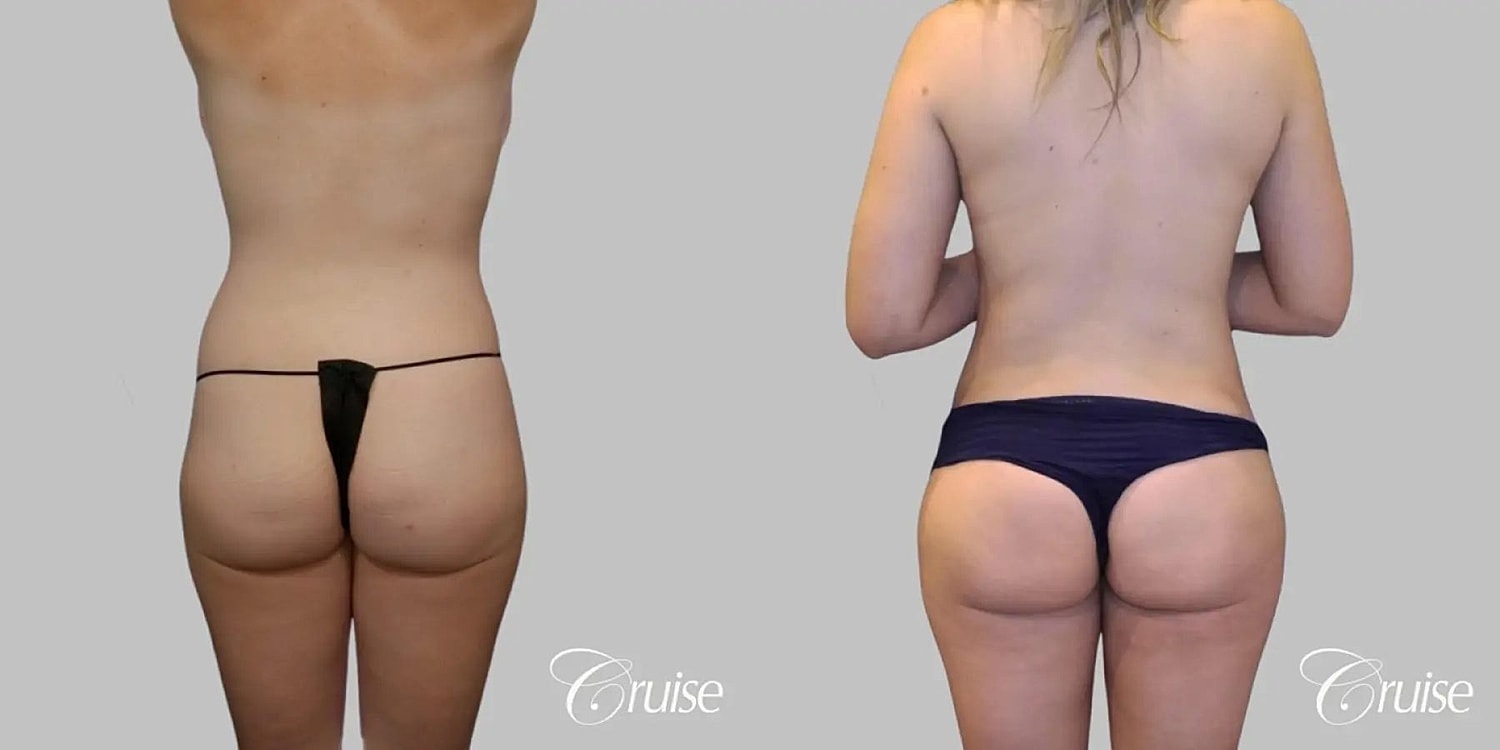 Brazilian Butt Lift Before & After