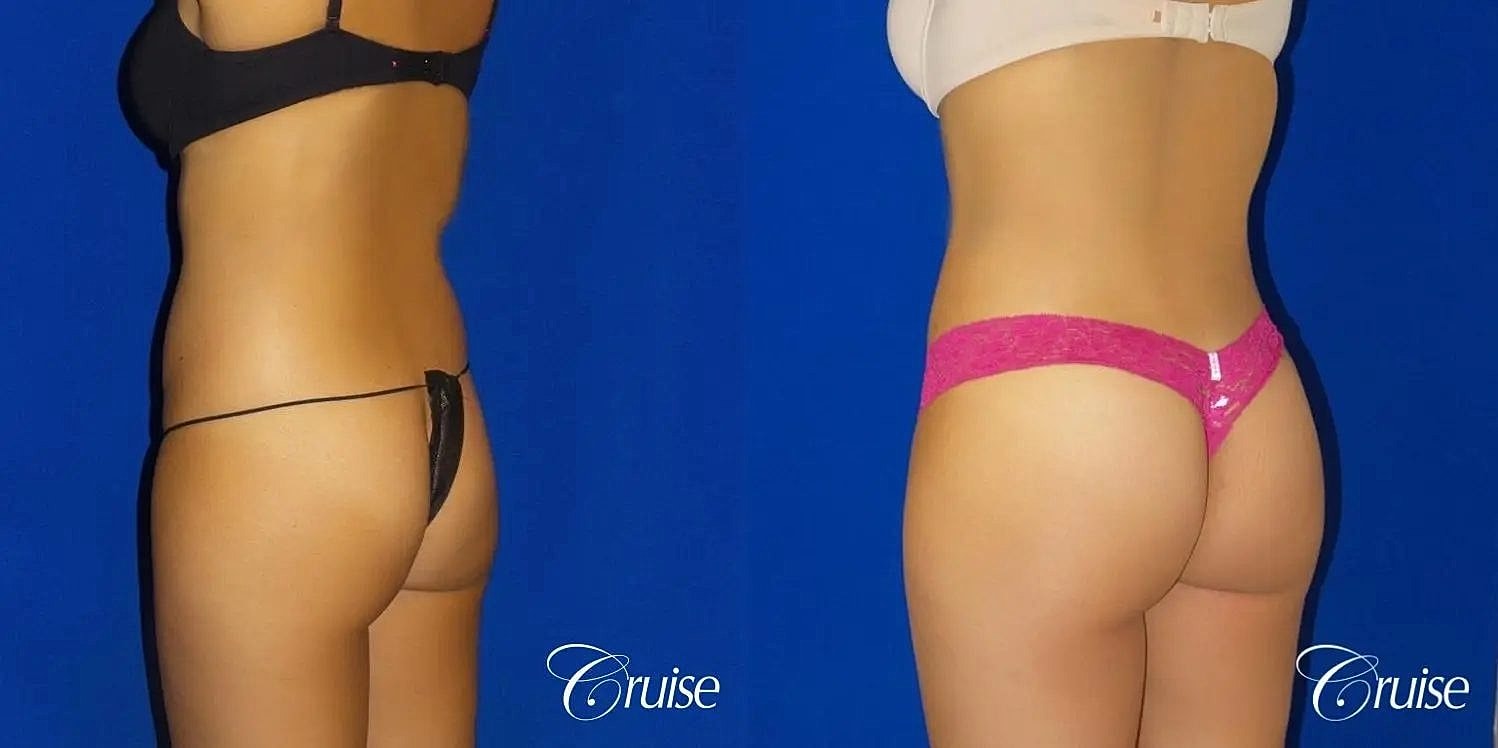 Brazilian Butt Lift Before & After