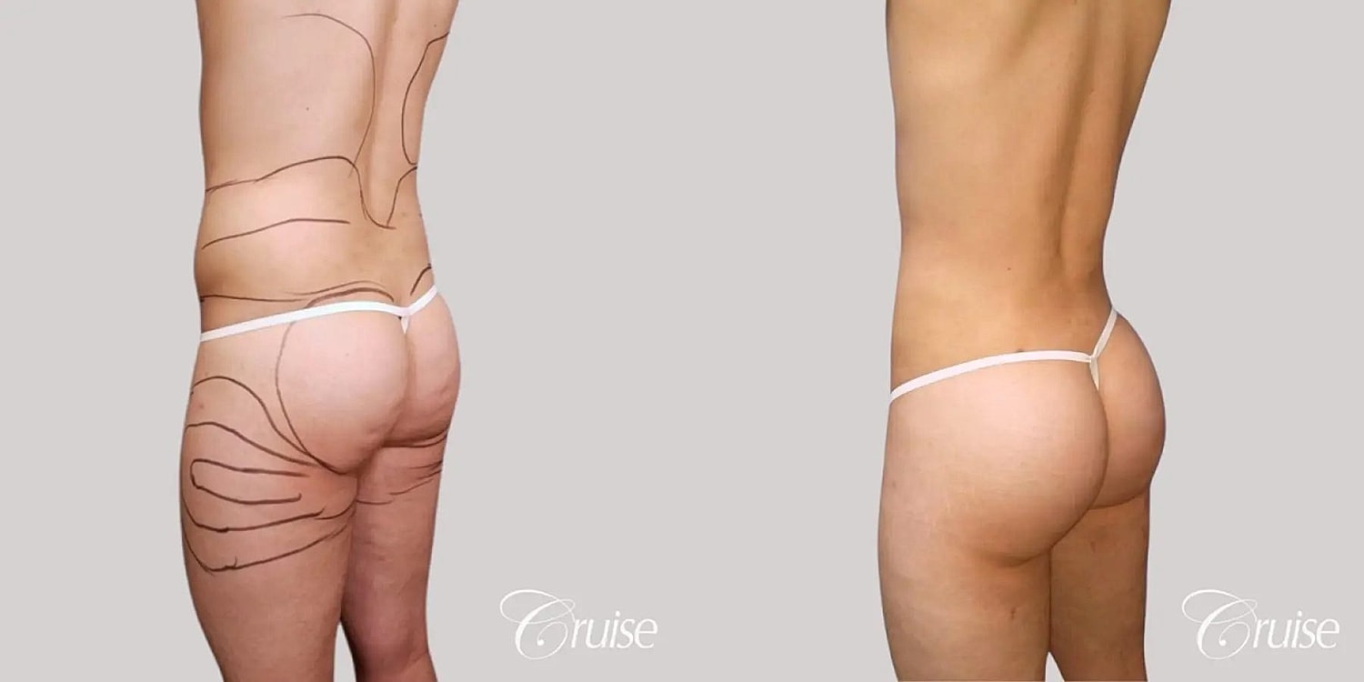 Brazilian Butt Lift Before & After