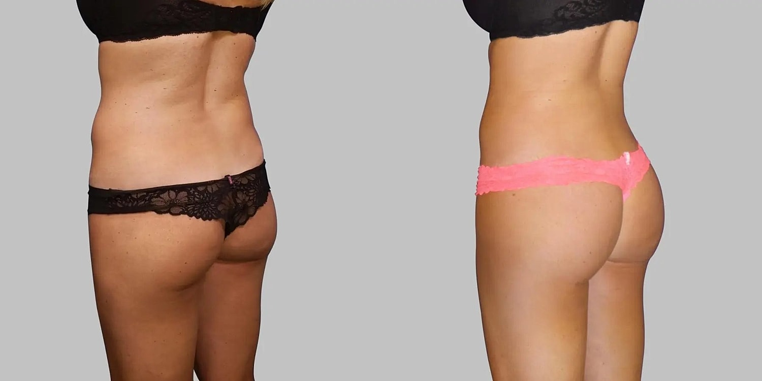 Brazilian Butt Lift Before & After
