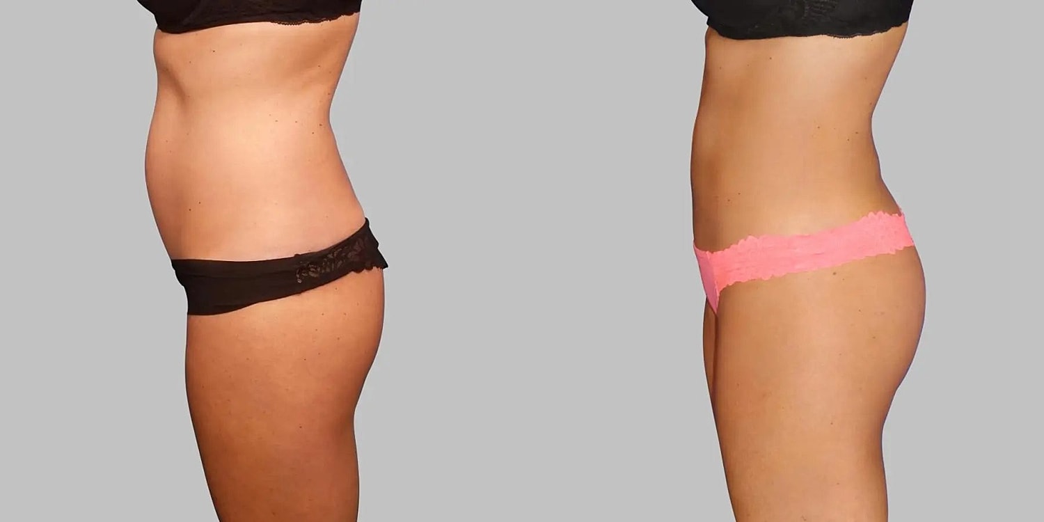 Brazilian Butt Lift Before & After