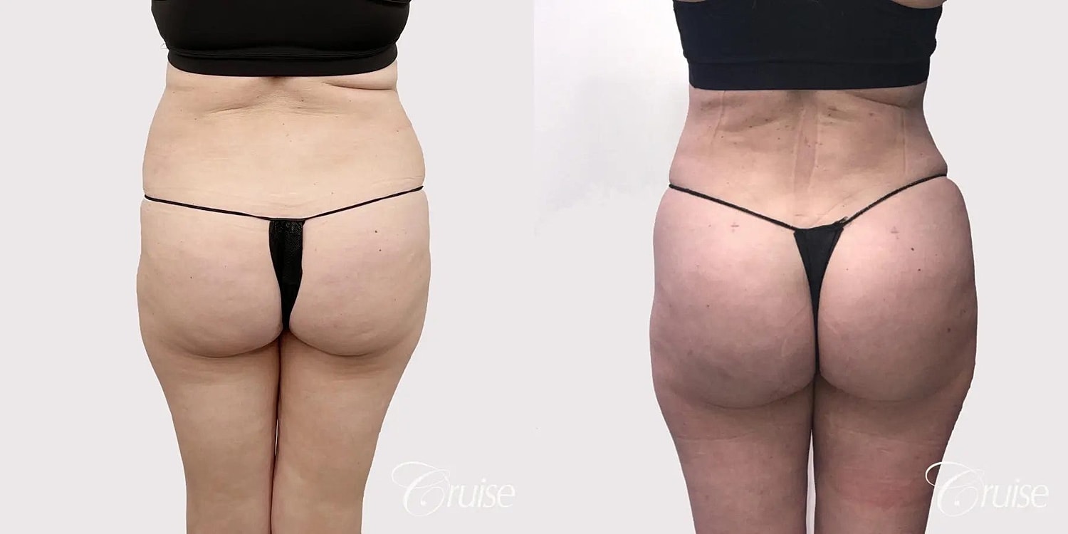 Brazilian Butt Lift Before & After
