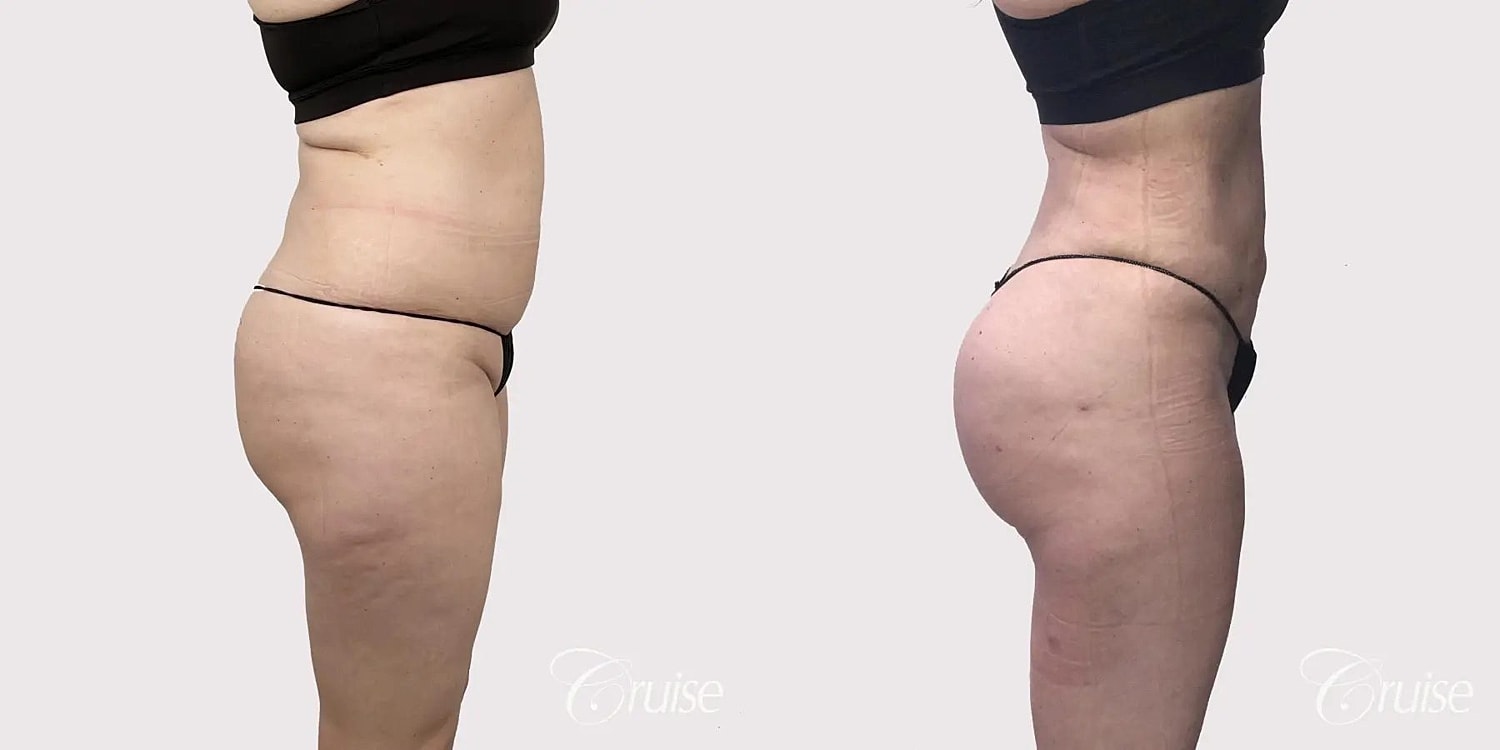 Brazilian Butt Lift Before & After