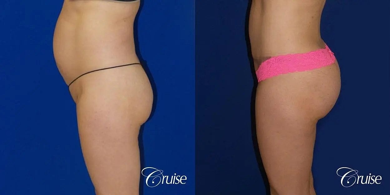 Brazilian Butt Lift Before & After