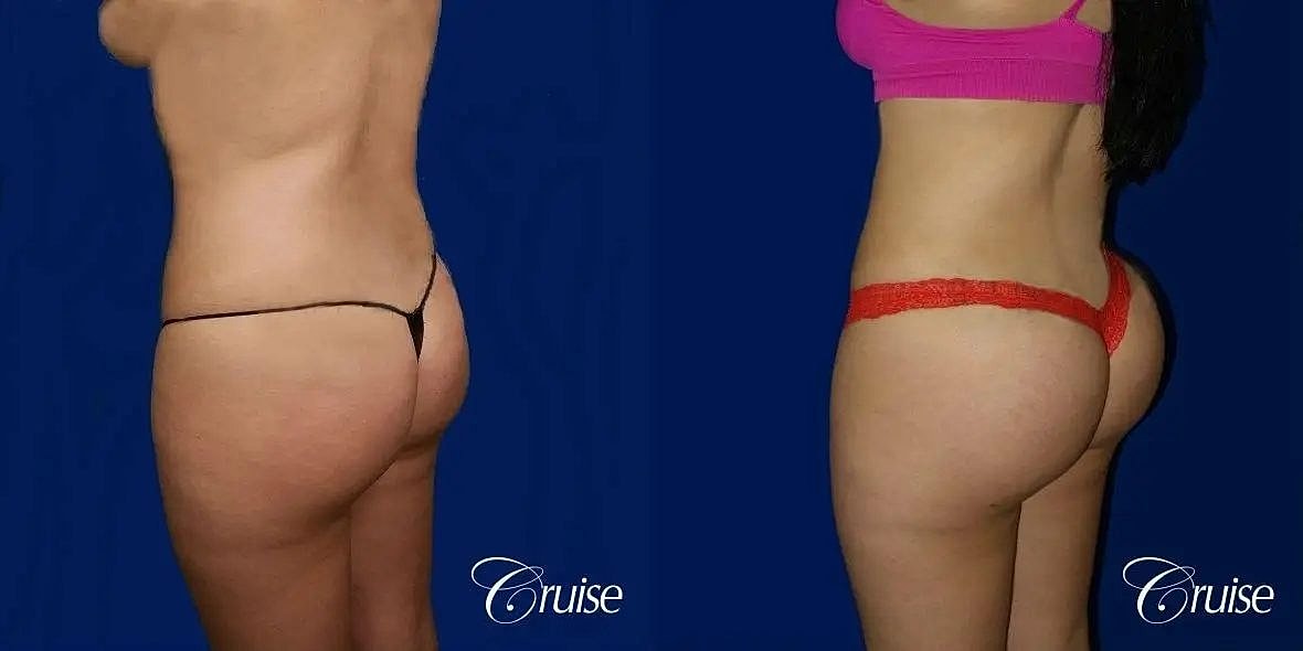 Brazilian Butt Lift Before & After