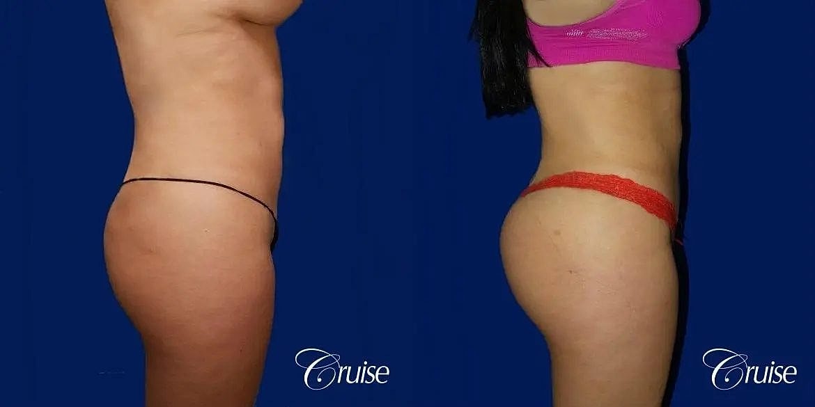 Brazilian Butt Lift Before & After