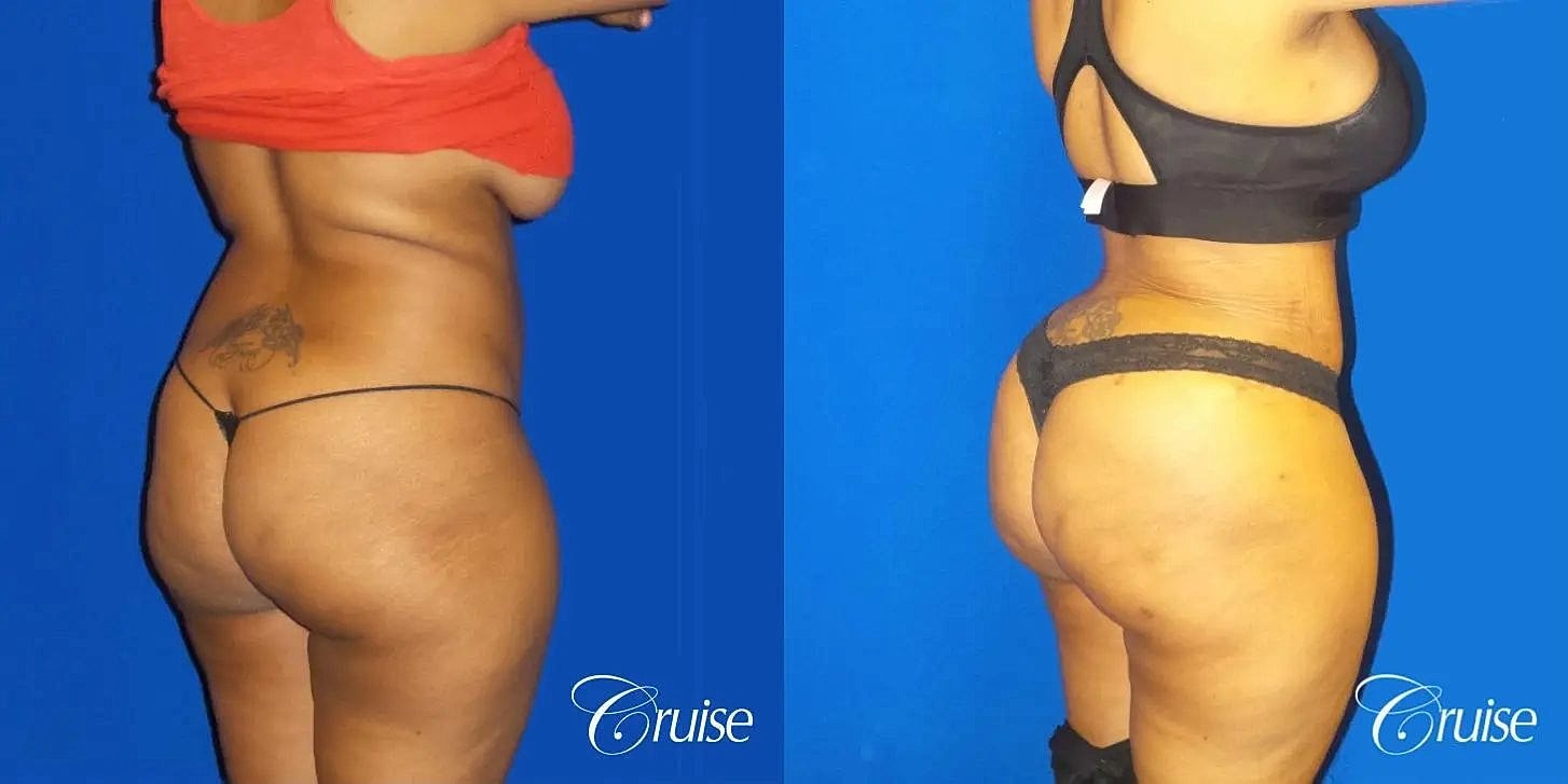 Brazilian Butt Lift Before & After