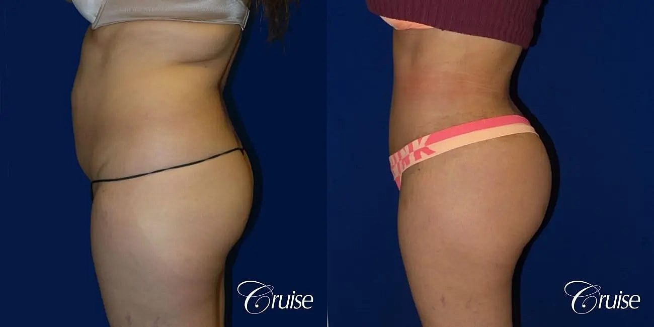Brazilian Butt Lift Before & After