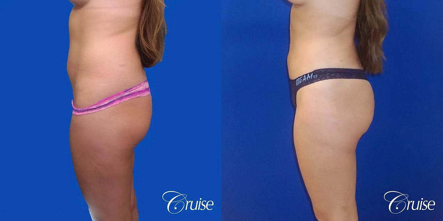 Brazilian Butt Lift Before & After