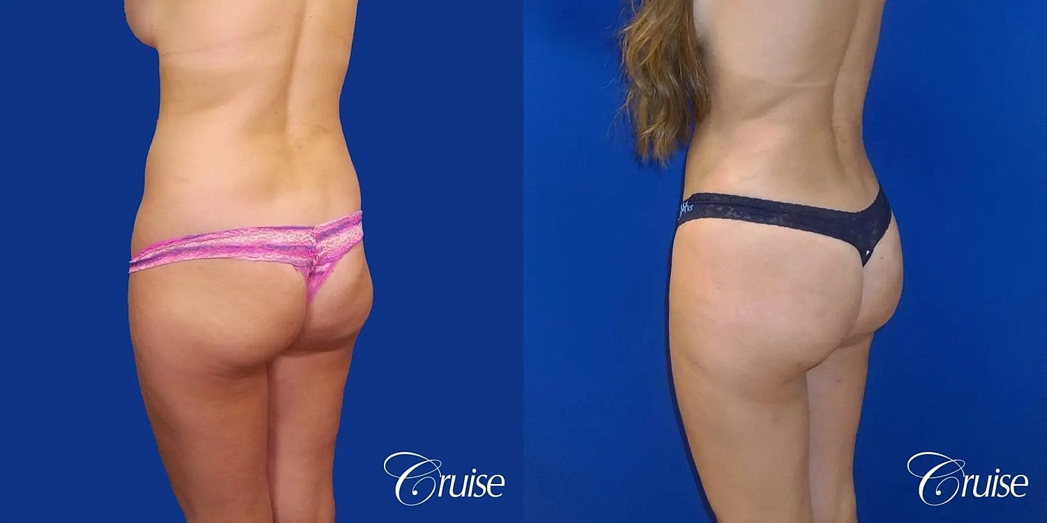 Brazilian Butt Lift Before & After