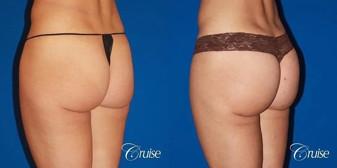 Brazilian Butt Lift Before & After