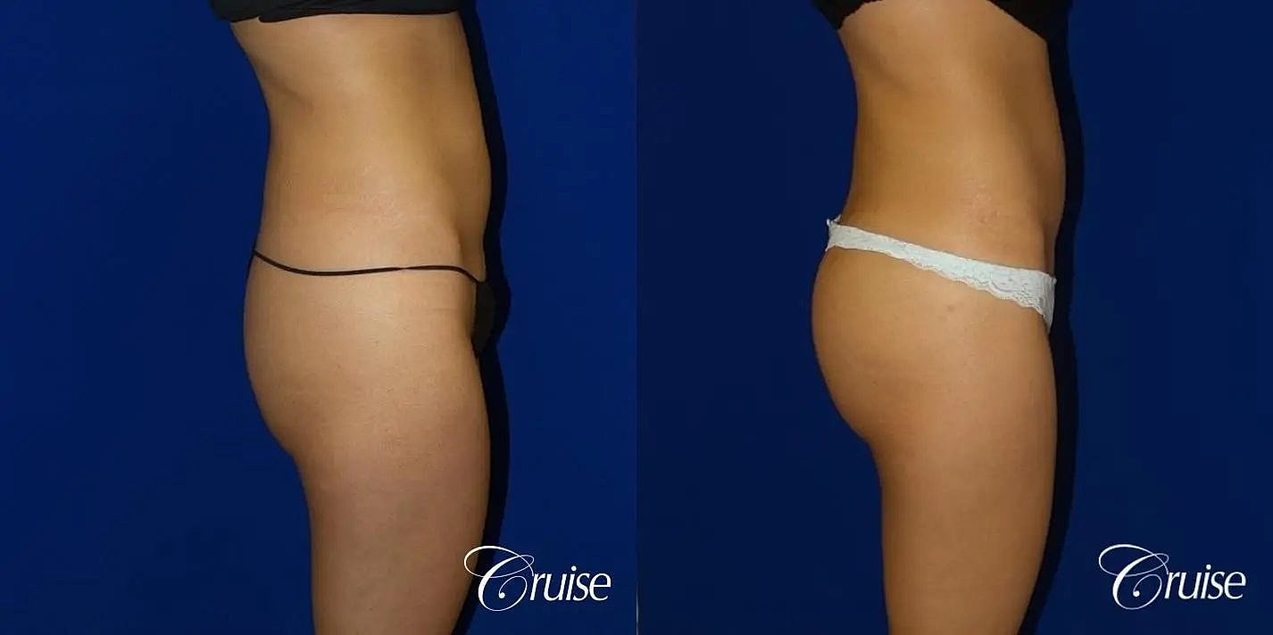 Brazilian Butt Lift Before & After