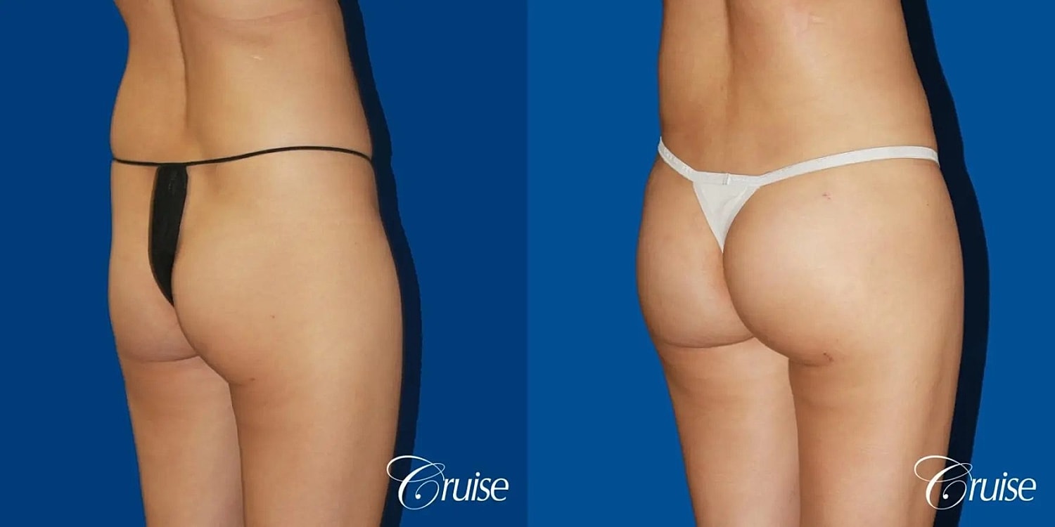 Brazilian Butt Lift Before & After