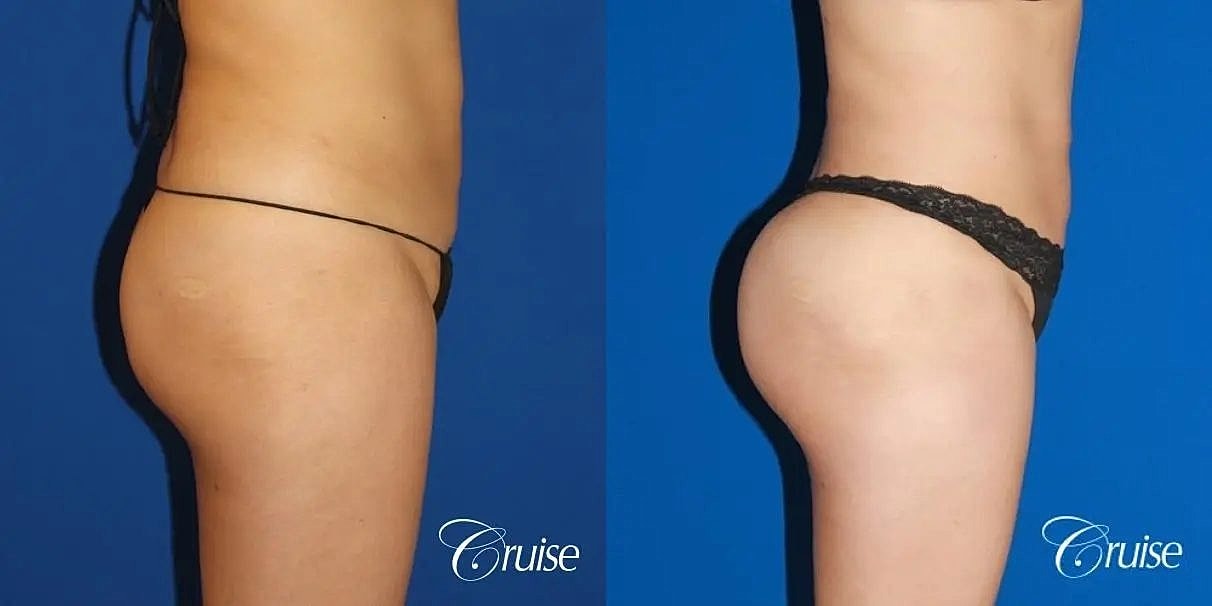 Brazilian Butt Lift Before & After