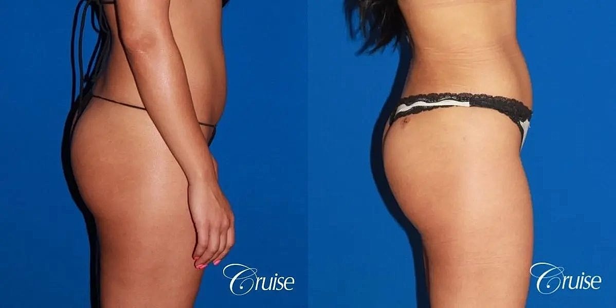 Brazilian Butt Lift Before & After
