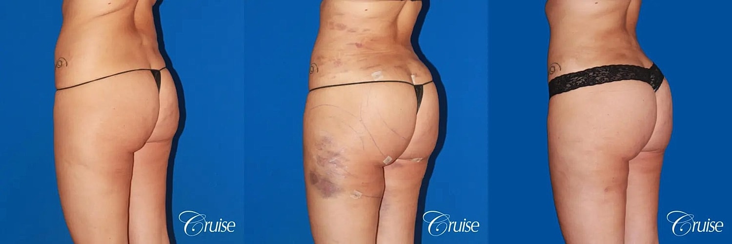 Brazilian Butt Lift Before & After