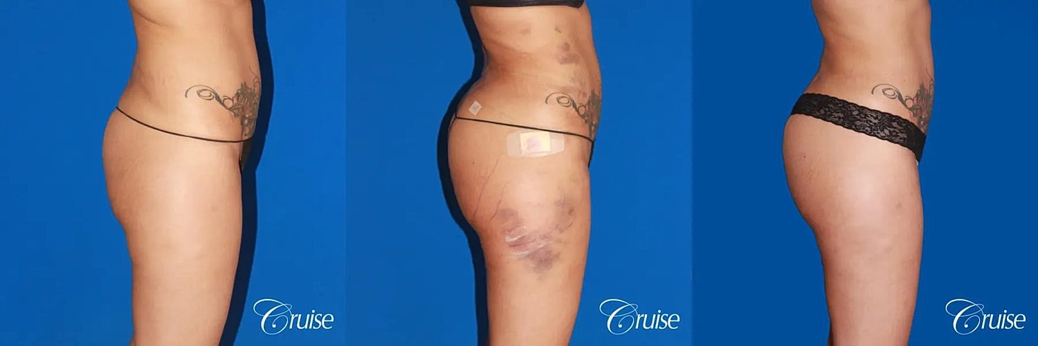 Brazilian Butt Lift Before & After