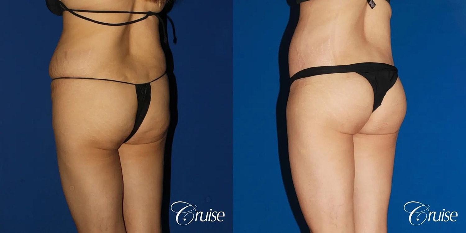 Brazilian Butt Lift Before & After