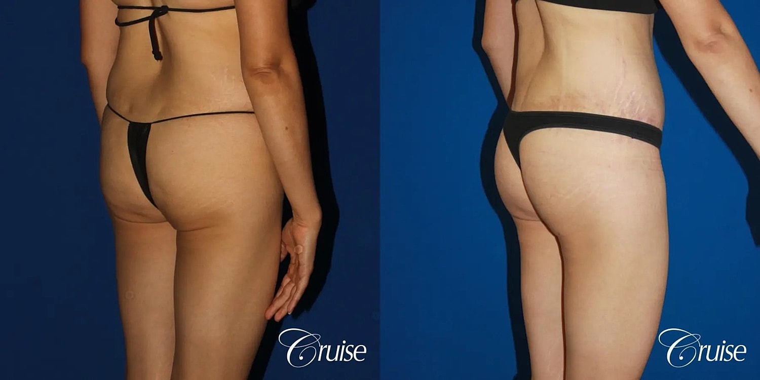 Brazilian Butt Lift Before & After