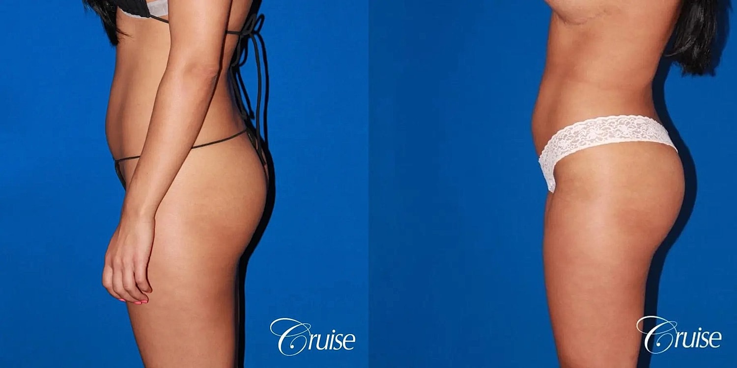 Brazilian Butt Lift Before & After