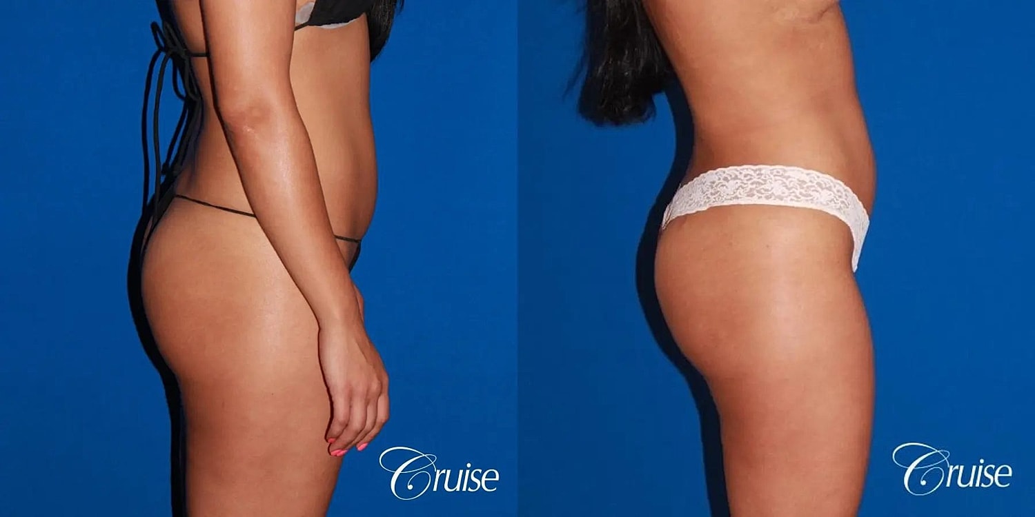 Brazilian Butt Lift Before & After