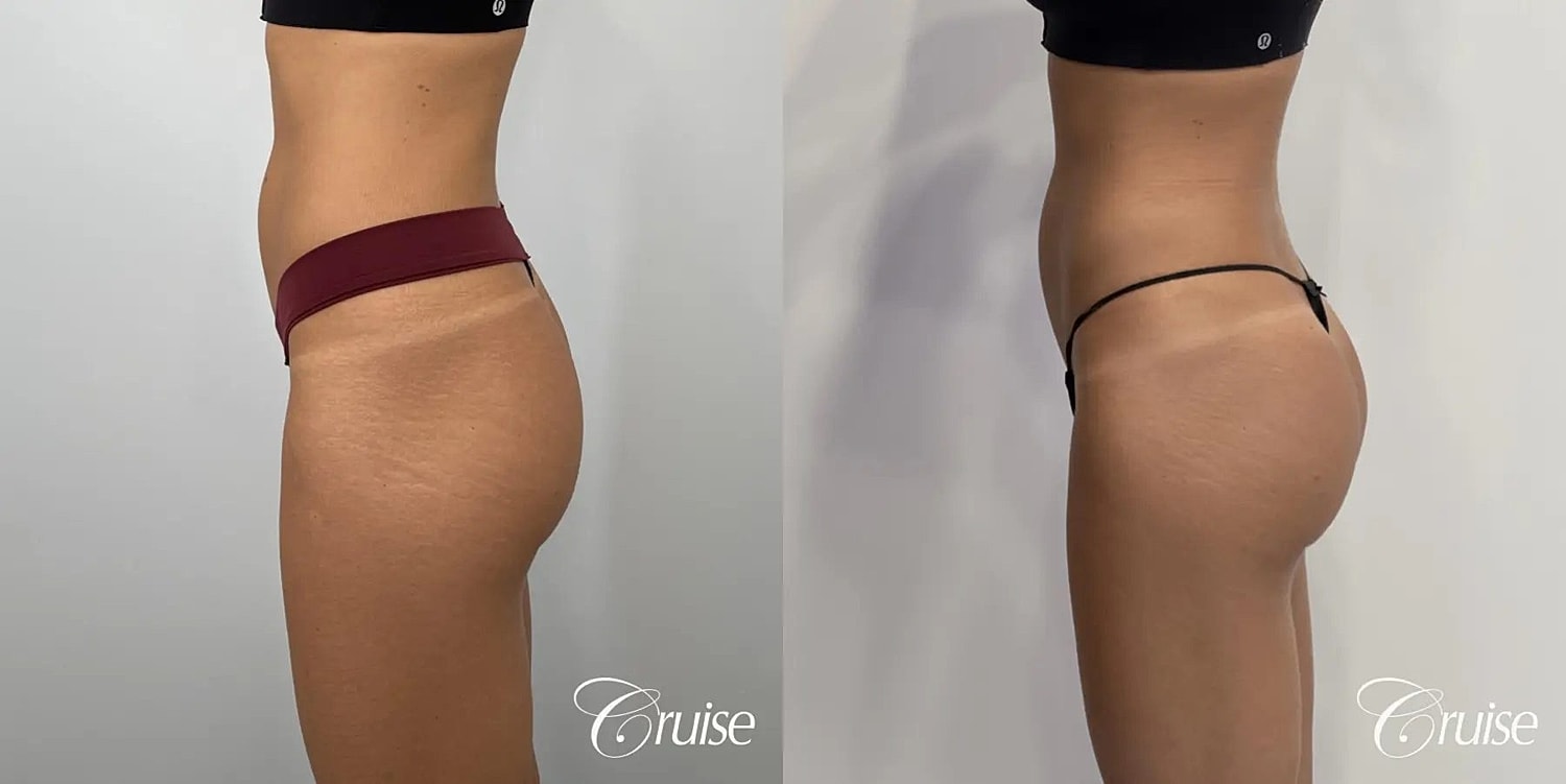 Brazilian Butt Lift Before & After