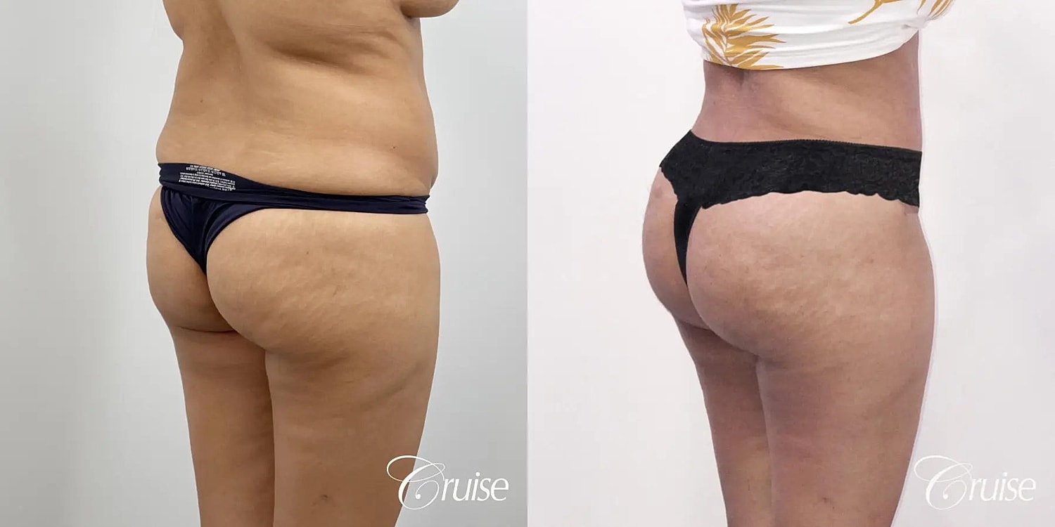 Brazilian Butt Lift Before & After
