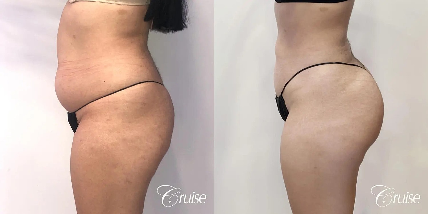 Brazilian Butt Lift Before & After