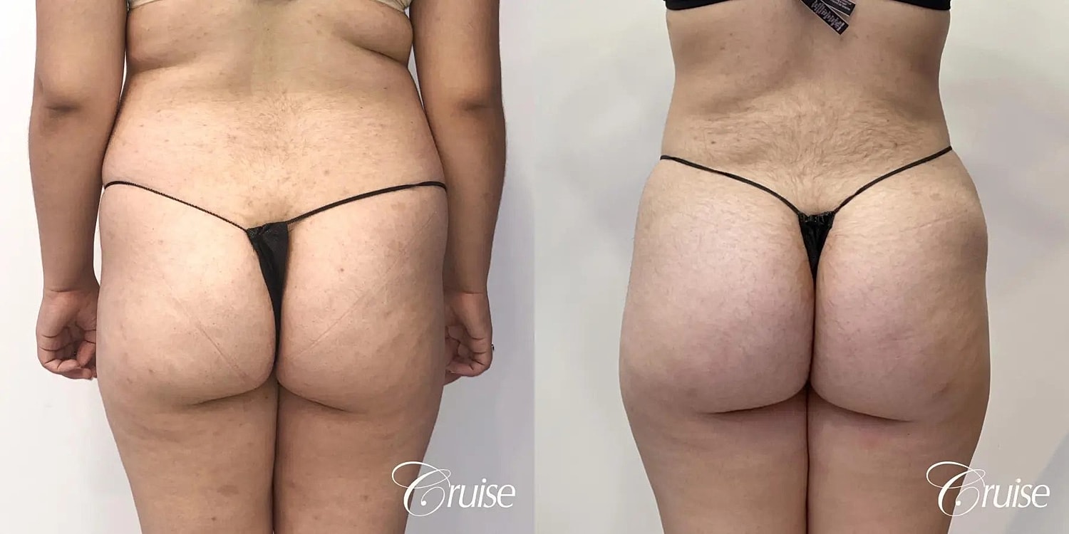 Brazilian Butt Lift Before & After