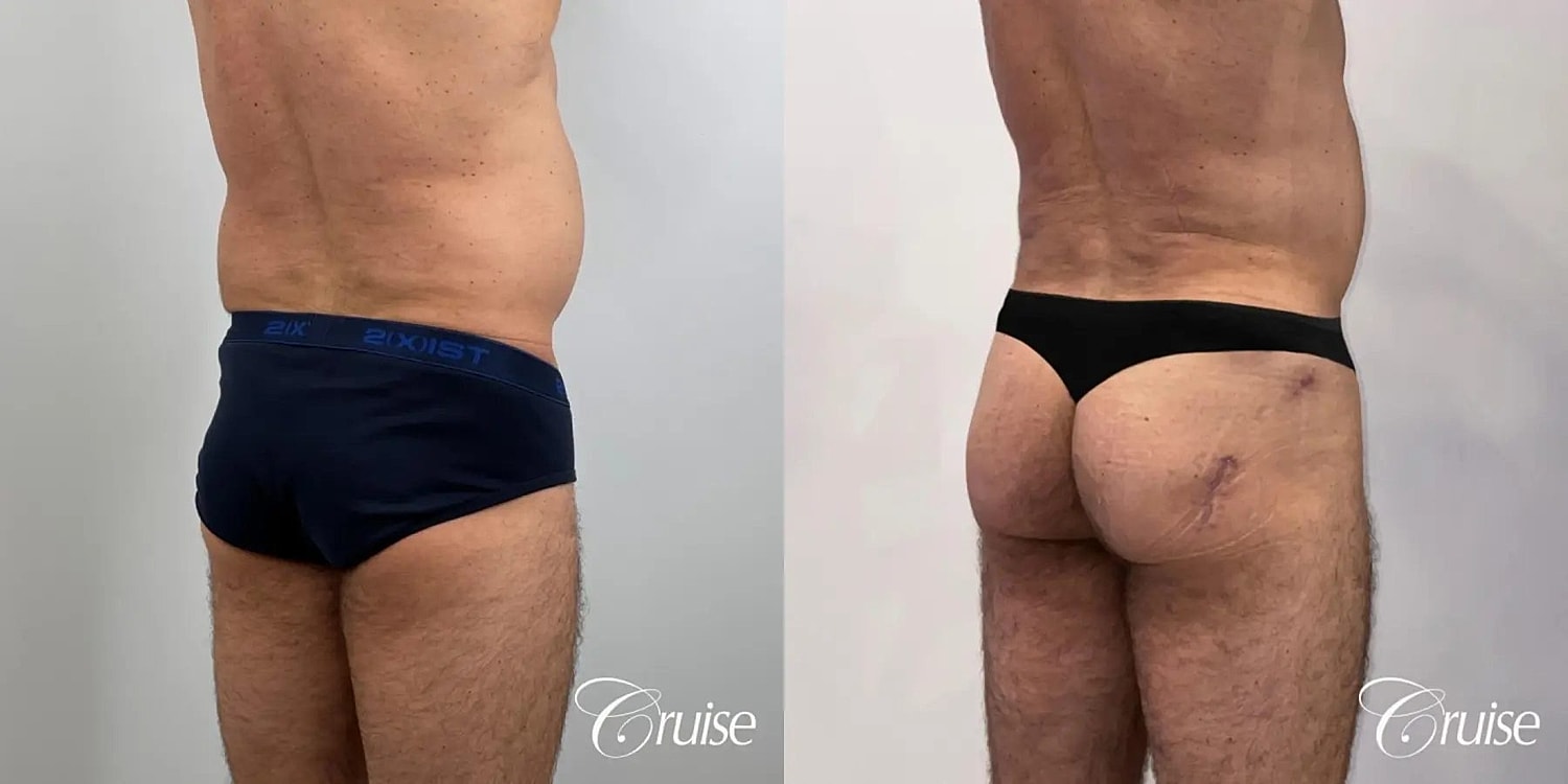 Brazilian Butt Lift Before & After