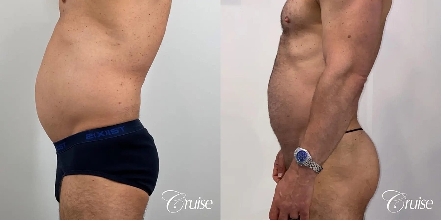 Brazilian Butt Lift Before & After