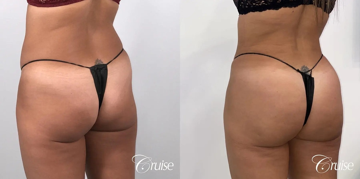 Brazilian Butt Lift Before & After