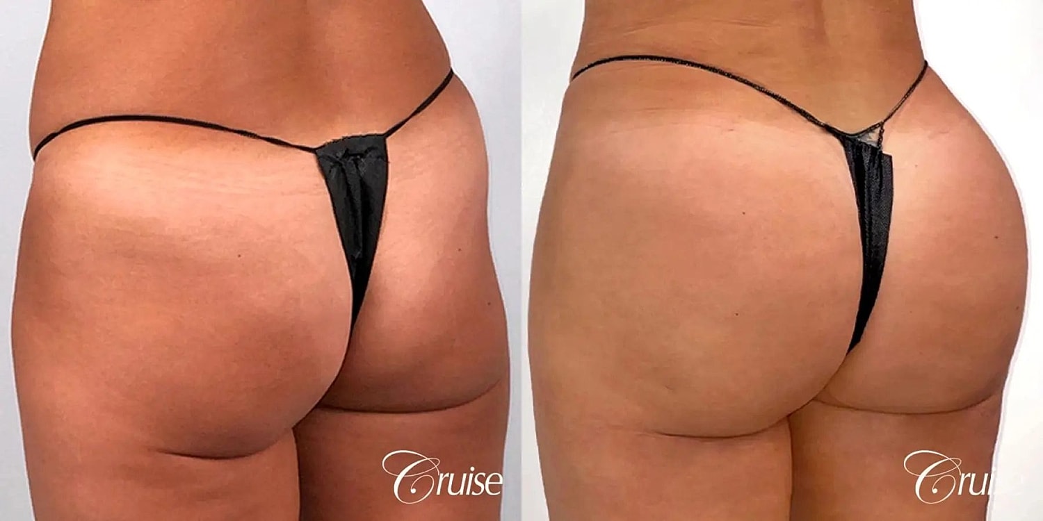 Brazilian Butt Lift Before & After