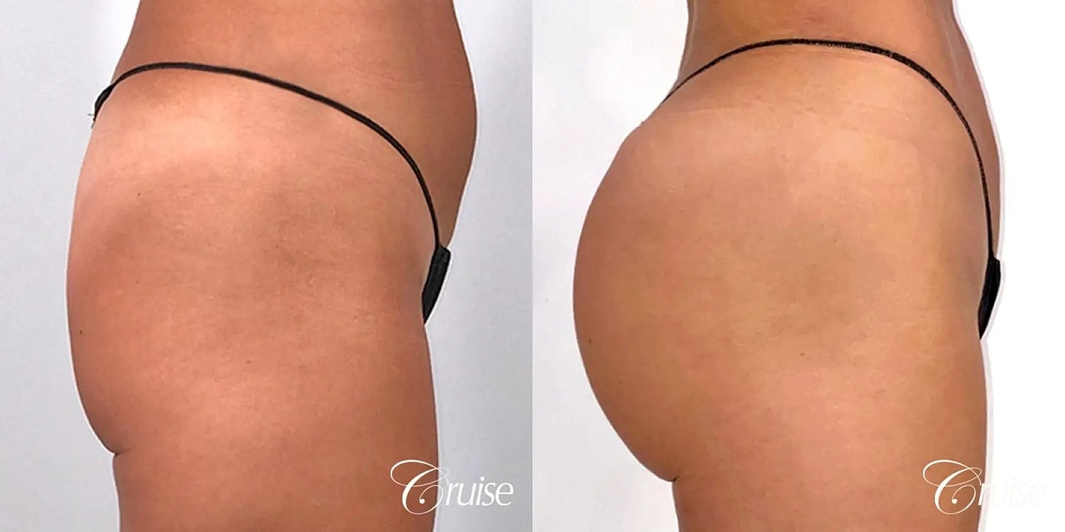 Brazilian Butt Lift Before & After