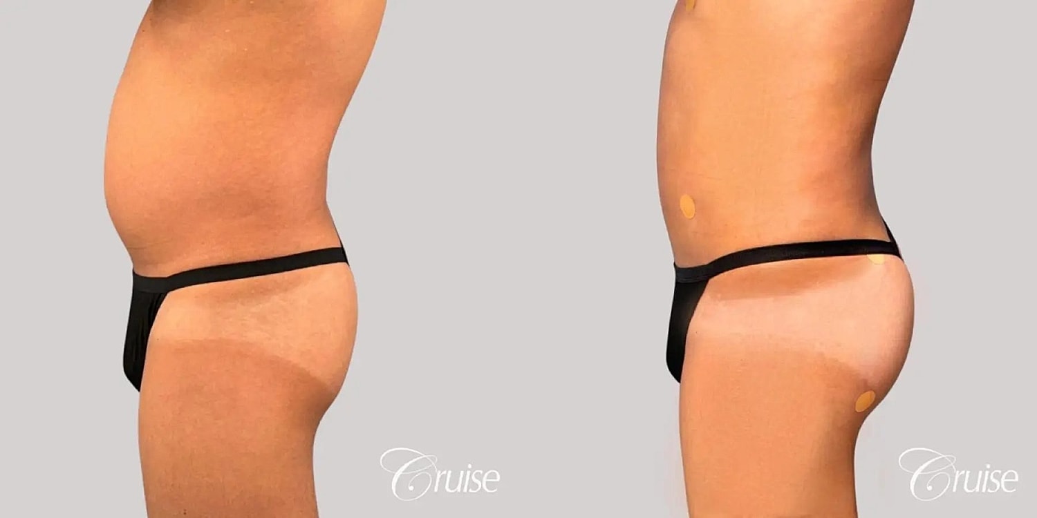 Brazilian Butt Lift Before & After