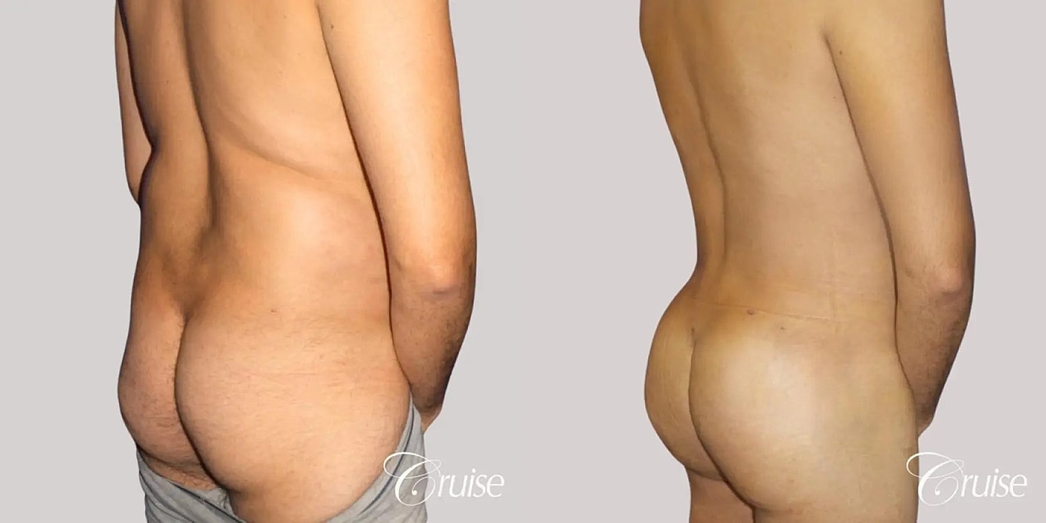 Brazilian Butt Lift Before & After