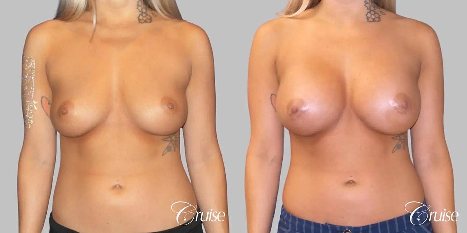 Breast Augmentation Before & After