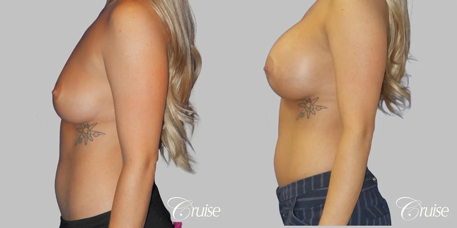 Breast Augmentation Before & After