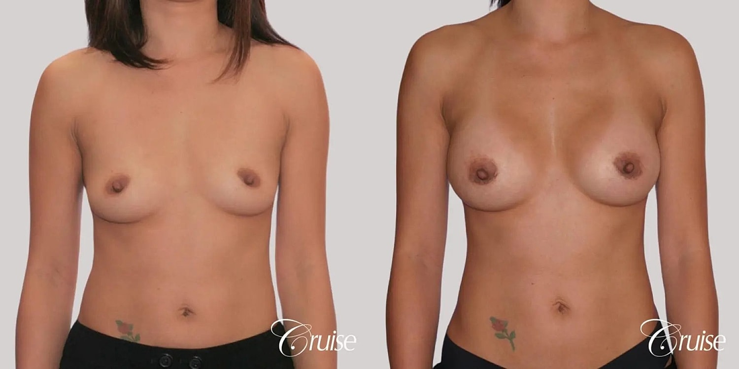 Breast Augmentation Before & After