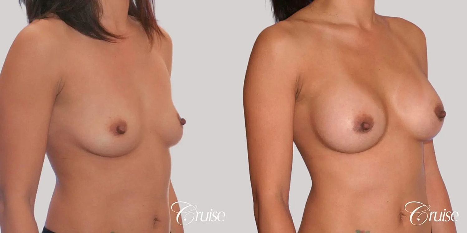 Breast Augmentation Before & After