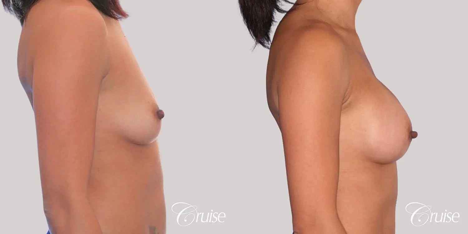 Breast Augmentation Before & After
