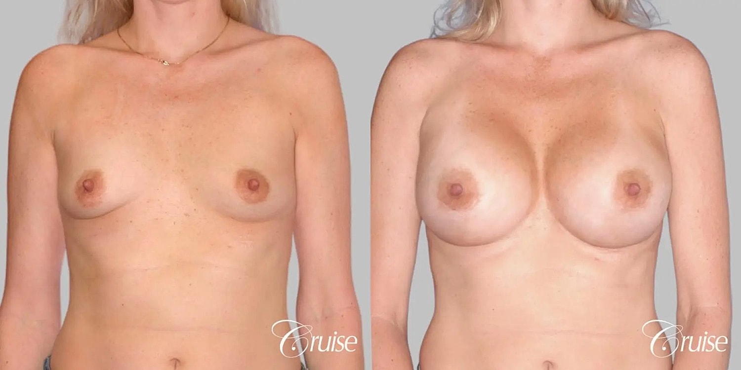 Breast Augmentation Before & After