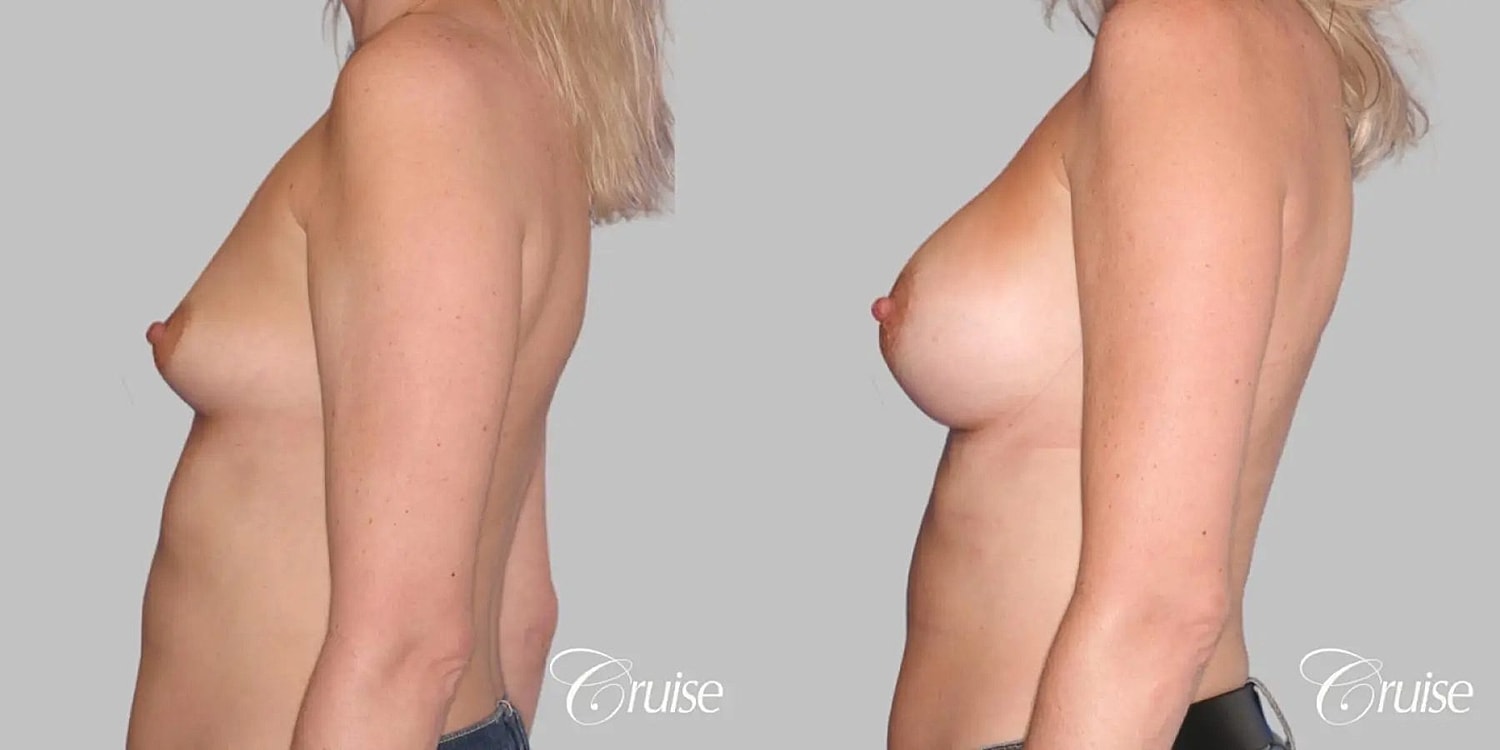 Breast Augmentation Before & After