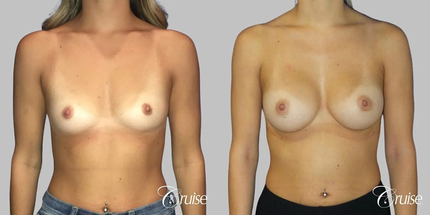 Breast Augmentation Before & After