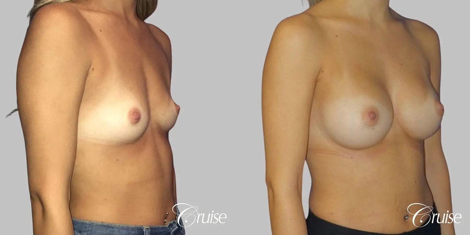 Breast Augmentation Before & After