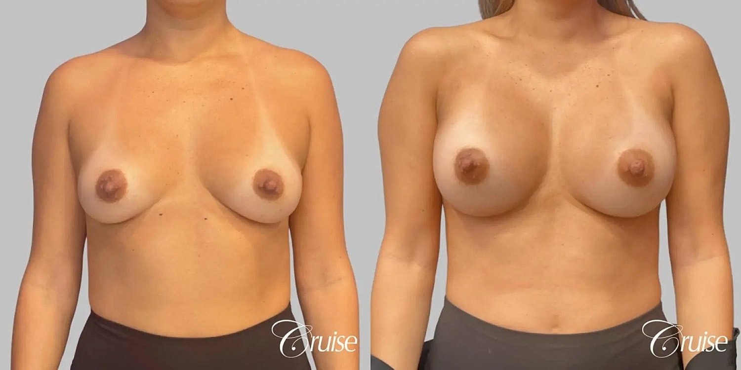 Breast Augmentation Before & After